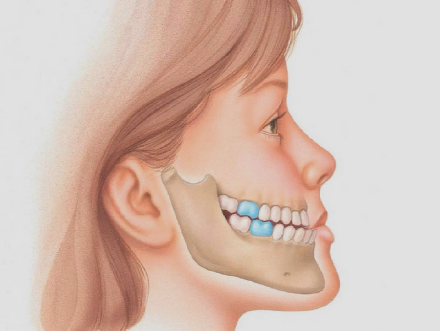 Удлиненная челюсть. Прогения нижней челюсти. Зубочелюстные аномалии мезиальный прикус. Мезиальный прикус нижней челюсти. Неправильный прикус прогения.