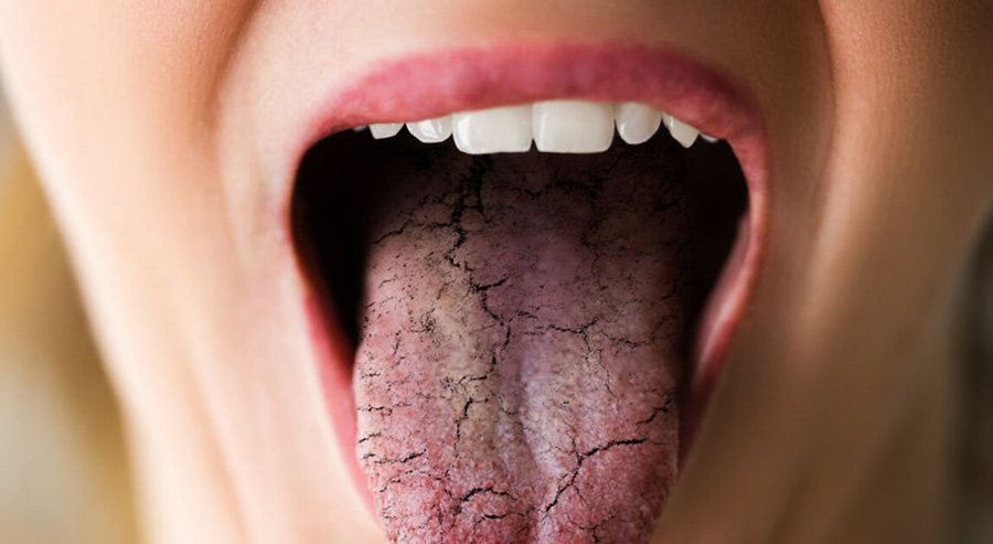 Ксеростомия ротовой полости. Ксеростомия (сухость в полости рта). Ксеростомия этиология.