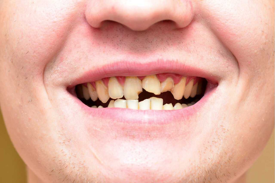 Почему ломаются зубы: основные причины и способы предотвращения